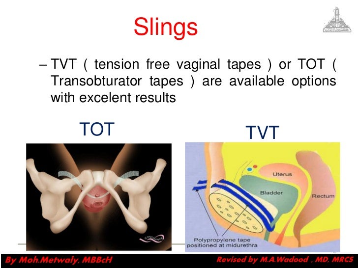 sex and masurbation stories transobturator vaginal tape
